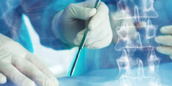 cirurgia-de-escoliose