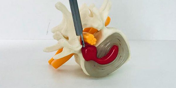 cirurgia-minimamente-invasiva-hernia-de-disco