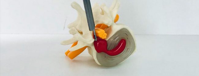 cirurgia-minimamente-invasiva-hernia-de-disco
