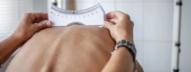 Doença-de-Scheuermann-aspectos-relevantes