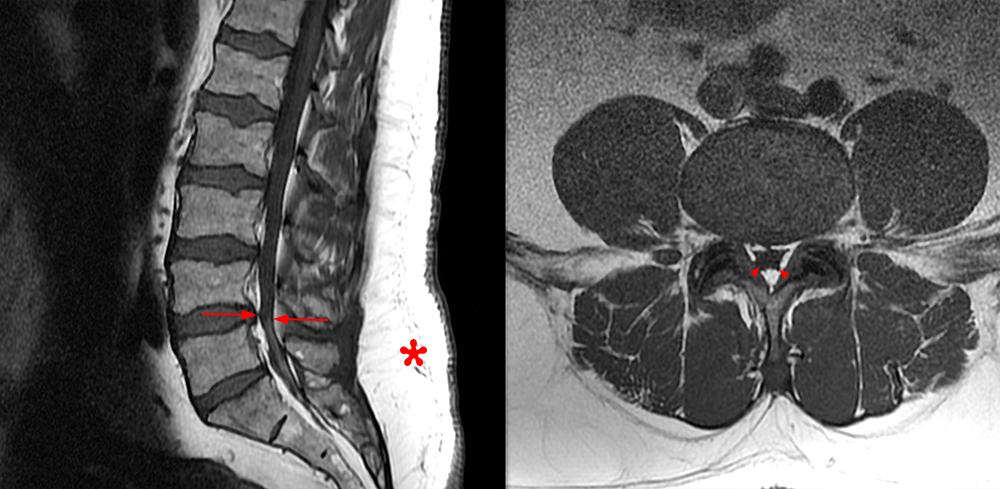 Ressonância magnética demonstrando acúmulo de gordura no espaço epidural com compressão do saco dural – Fonte: Radsource
