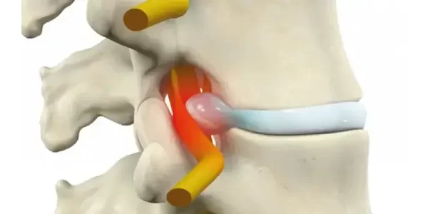 hérnia de disco (1)