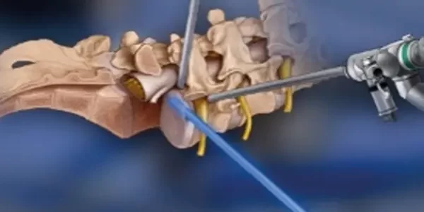 Endoscopia da coluna